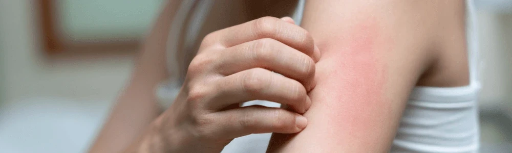 Kuidas allergiline lööve ära tunda ja mida selle korral teha?