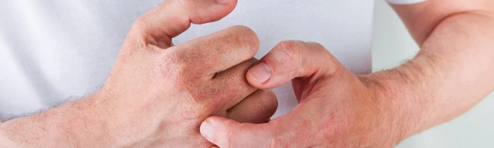 Kas ir ekzēma un kāpēc tā rodas?