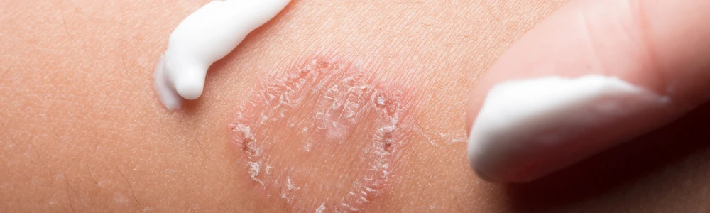 Dermatofütoos - mida peaks naha seeninfektsioonist teadma?