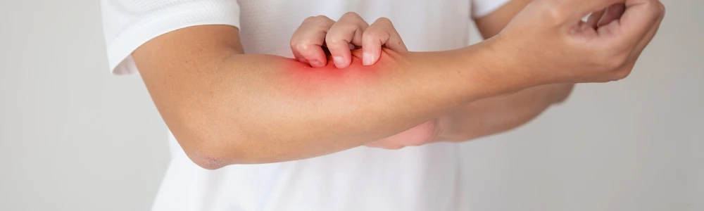 10 levinud küsimust psoriaasi kohta