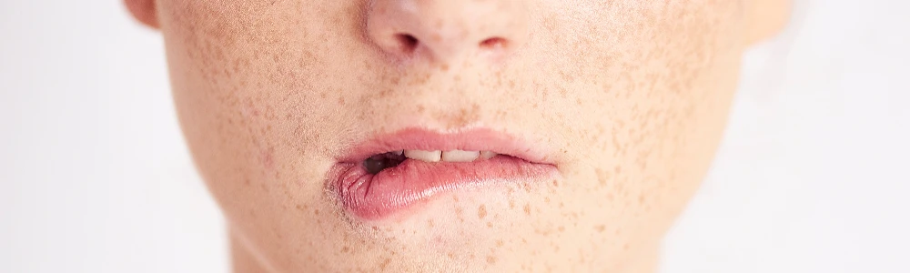 Herpes vīruss – Kāpēc simptomi atgriežas un kā tos samazināt?