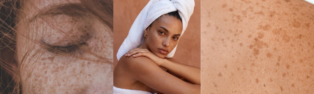 Mis on hüperpigmentatsioon ja kuidas seda ravida?