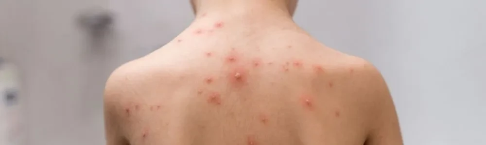 Vējbakas simptomi un efektīvākās ārstēšanas metodes